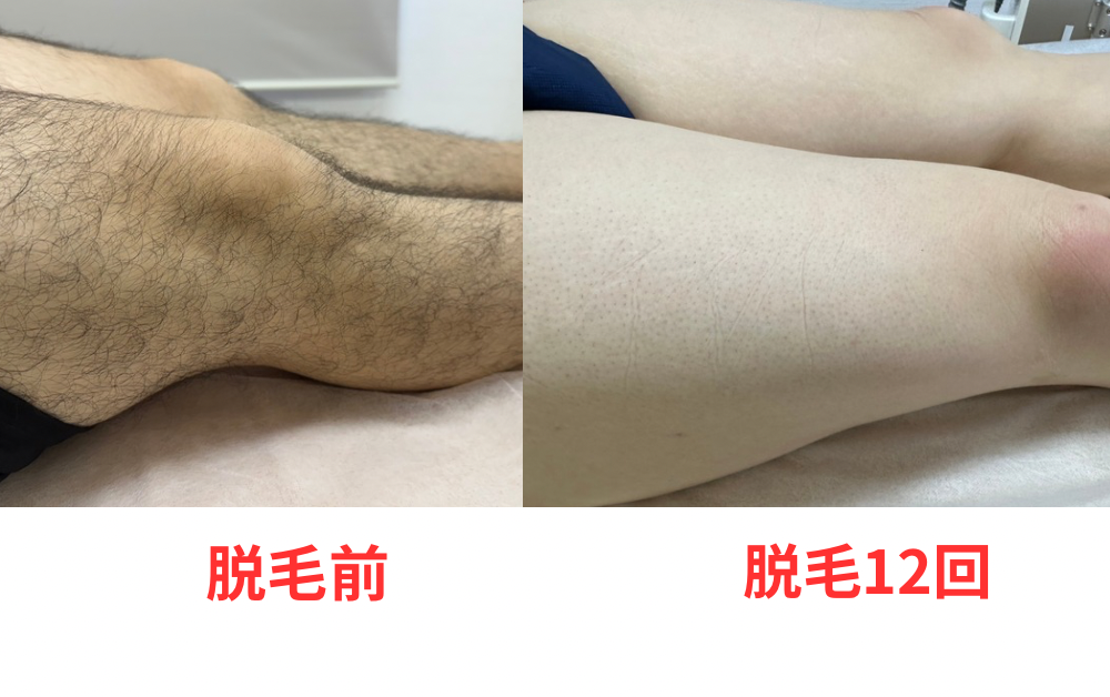 脱毛前 - 6