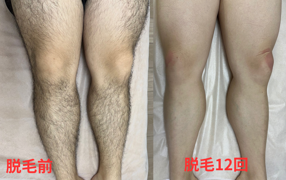 脱毛前 - 7