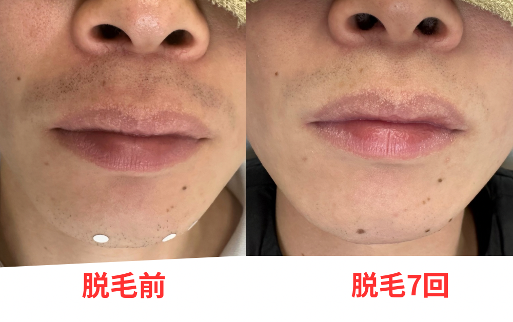 脱毛前 - 2